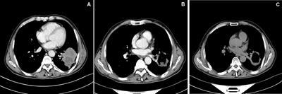 Efficacy and safety of CalliSpheres drug-eluting beads for bronchial arterial chemoembolization for refractory non-small-cell lung cancer and its impact on quality of life: A multicenter prospective study